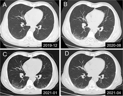 Characteristics of Anti-Contactin1 Antibody-Associated Autoimmune Nodopathies With Concomitant Membranous Nephropathy